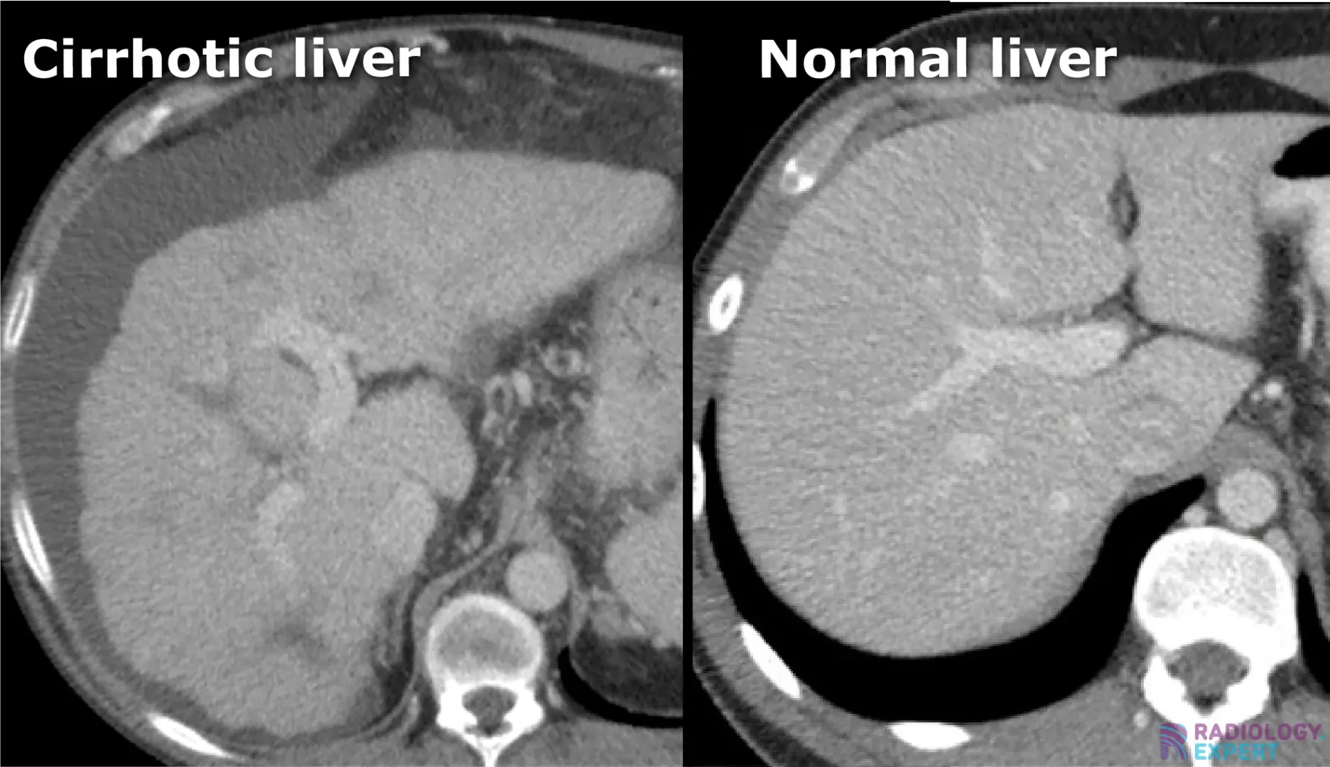 Abdominal CT examination: liver cirrhosis