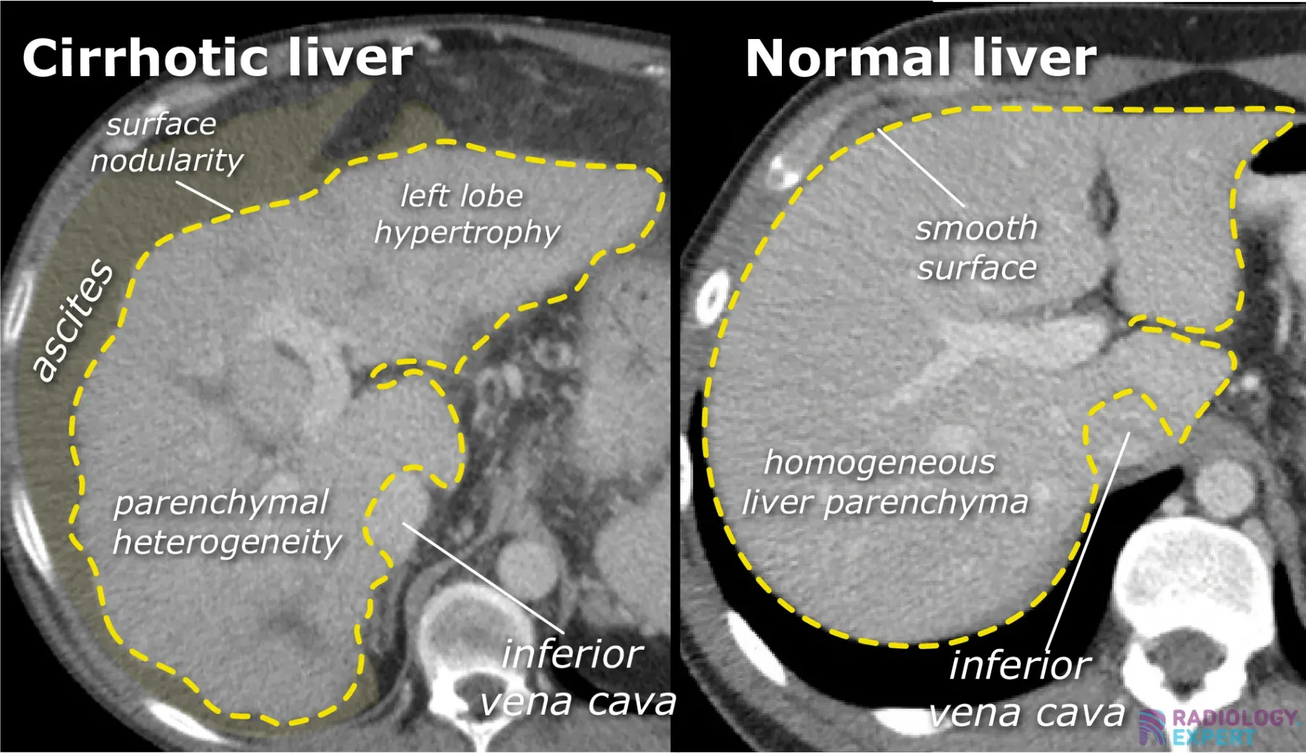 Abdominal CT examination: liver cirrhosis