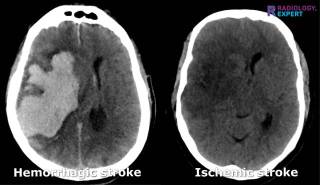 Hemorrhagic stroke and ischemic stroke on CT