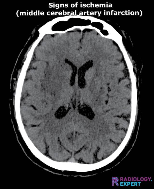 ischemic sigs MCA infarction on CT. Insular ribbon sign. Blurring basal ganglia