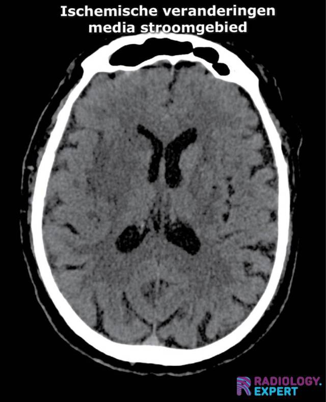 ischemische veranderingen op CT bij media infarct. Insular ribbon sign. Verstrijking basale kernen