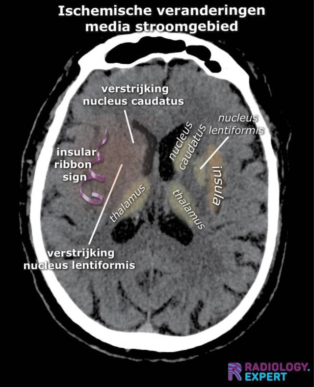 ischemische veranderingen op CT bij media infarct. Insular ribbon sign. Verstrijking basale kernen