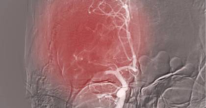 Interventieradiologie - De CVA Patient