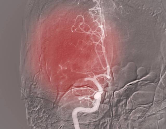 Interventional Radiology - The Stroke Patient