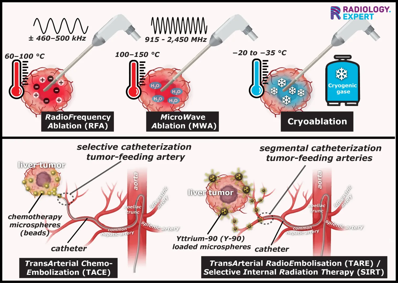 image-guided oncological treatments, tumor ablations, RFA, MWA, cryoablation, TACE, TARE, SIRT