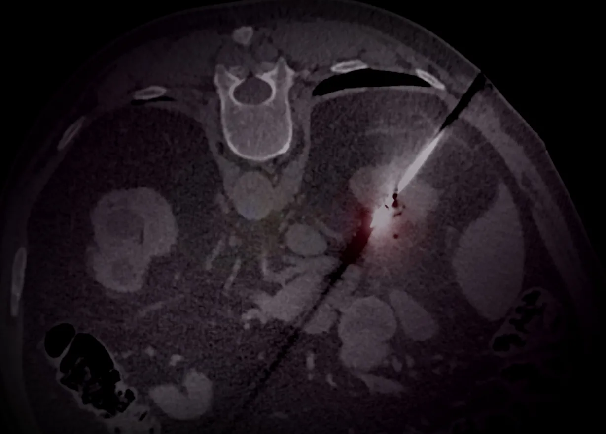 Module Interventional Radiology - Oncological