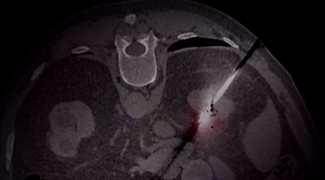 Interventie Radiologie - Oncologisch