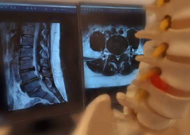 MRI Lumbar Spine