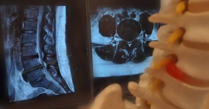MRI lumbale wervelkolom