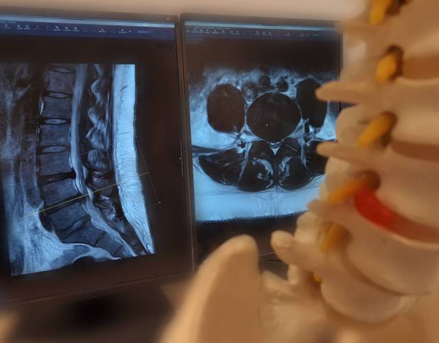MRI lumbale wervelkolom