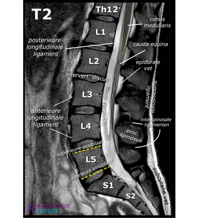 Anatomie MRI lumbale wervelkolom