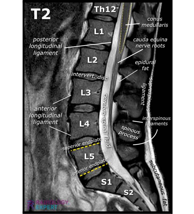 Anatomy MRI lumbar spine