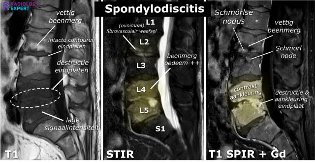 MRI lumbale wervelkolom