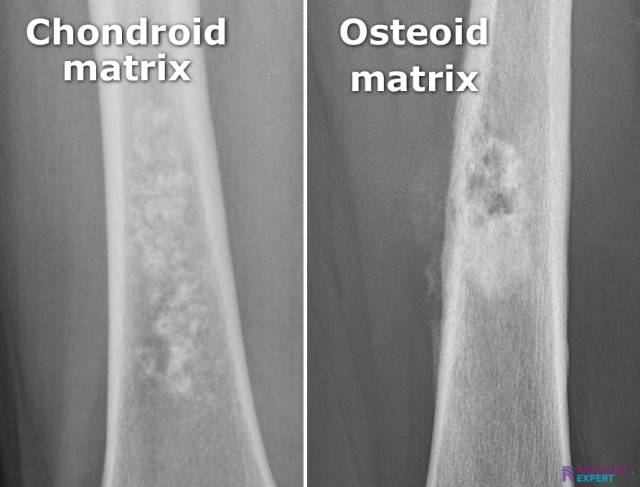 osseous lesions with chondriod and osteoid matrix