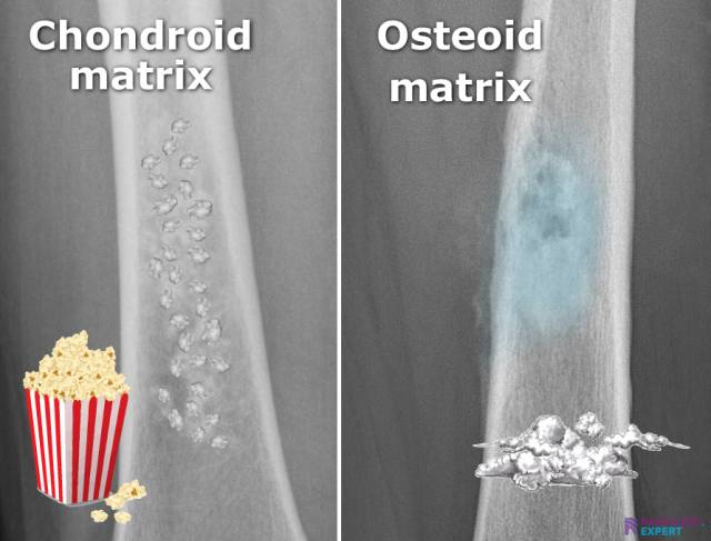 osseous lesions with chondriod and osteoid matrix