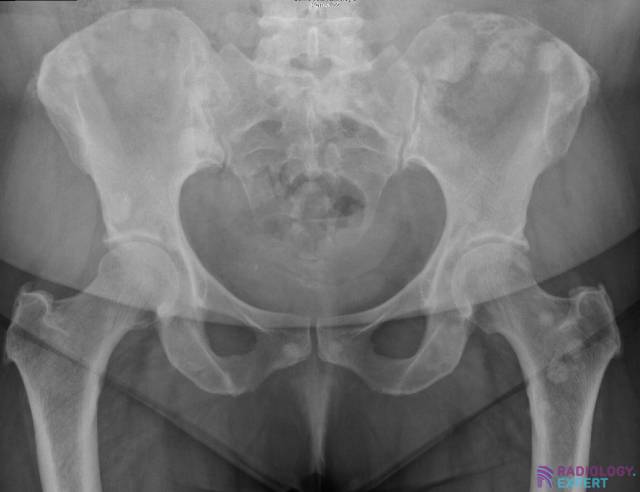 Multiple sclerotic (= blastic) lesions consistent with osseous metastases.