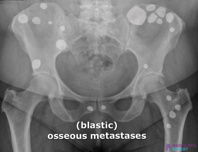 Multiple sclerotic (= blastic) lesions consistent with osseous metastases.