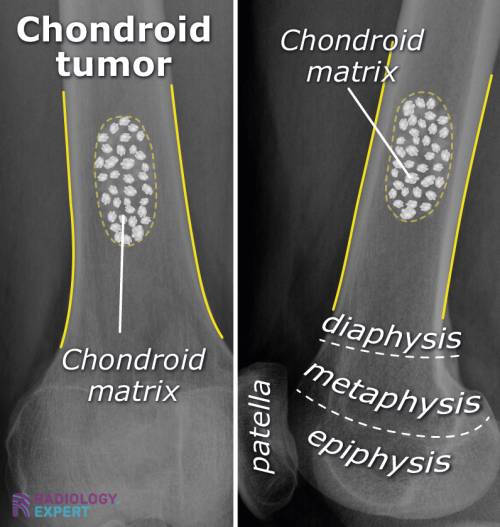 Bone Tumours