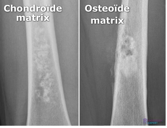 Chondroïde matrix en osteoïde matrix bij ossale laesies