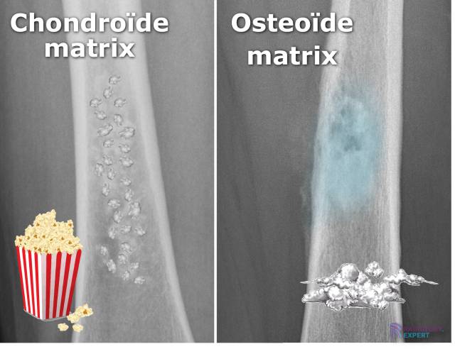 Chondroïde matrix en osteoïde matrix bij ossale laesies