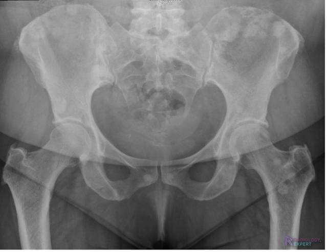 Multipele sclerotische (= blastische) laesies bij ossaal gemetastaseerd mammacarcinoom.