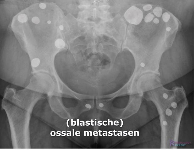 Multipele sclerotische (= blastische) laesies bij ossaal gemetastaseerd mammacarcinoom.