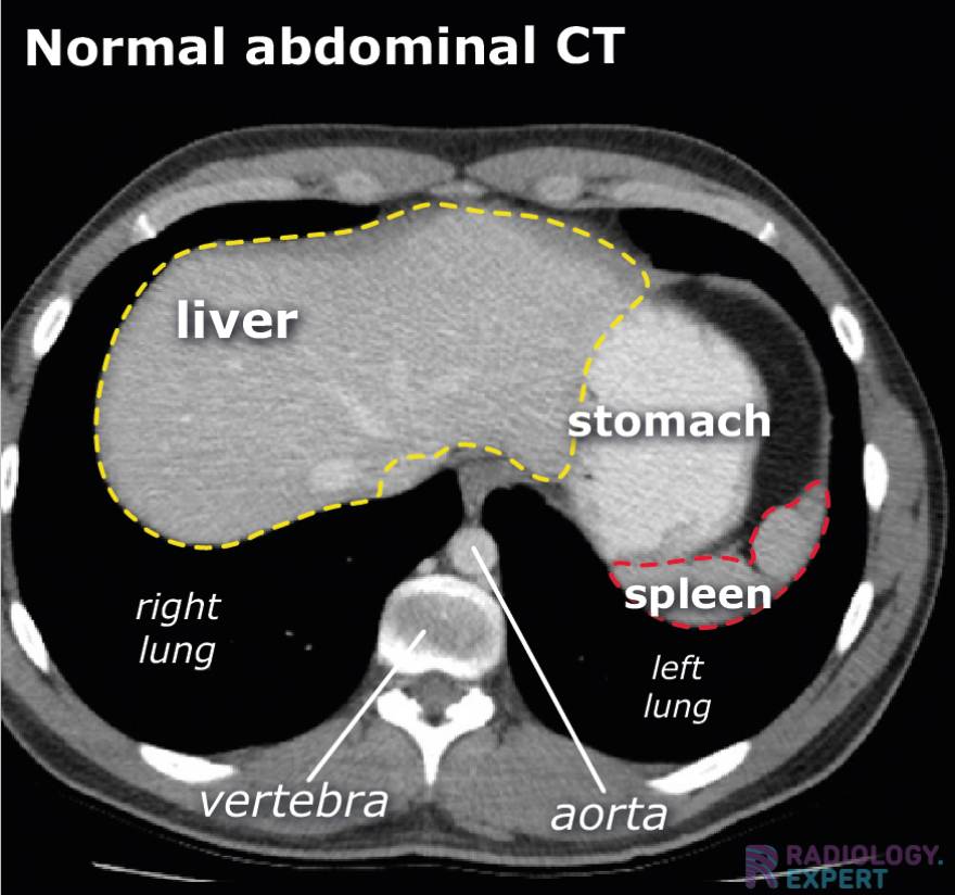 Labelled Female Ct Scan Abdomen at Faith Sager blog