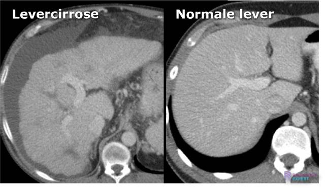 Levercirrose op een CT abdomen onderzoek