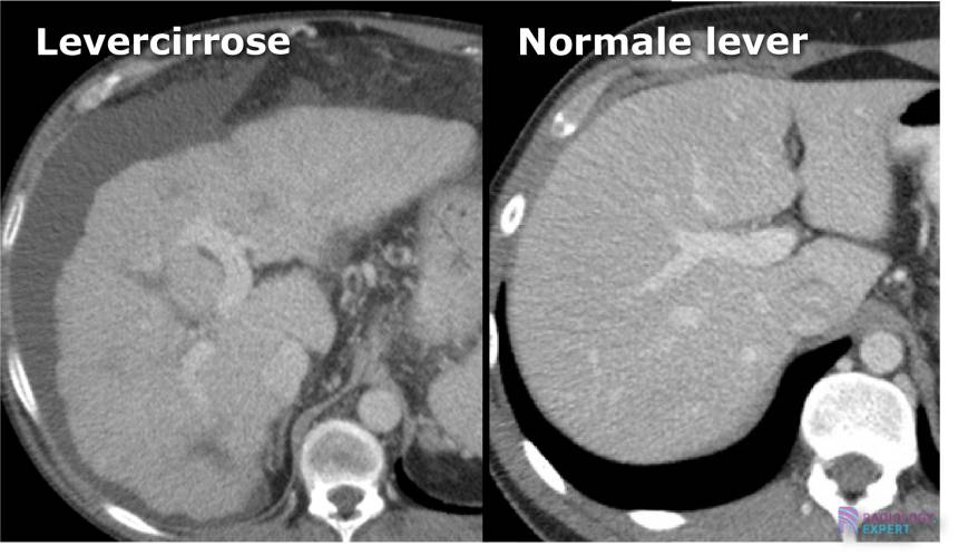 CT Abdomen Algemeen ct-abdomen-algemeen