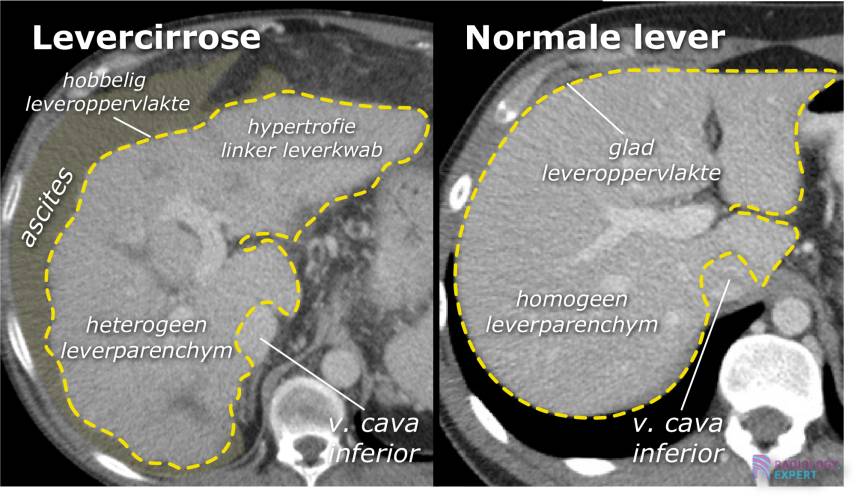 CT abdomen algemeen