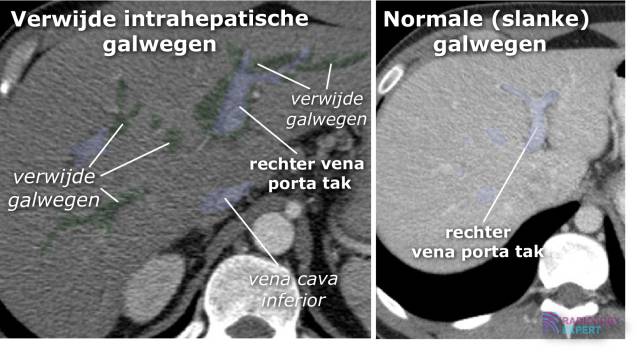 Slanke Intra En Extrahepatische Galwegen