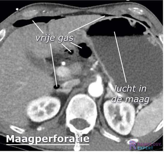 CT Abdomen Algemeen ct-abdomen-algemeen