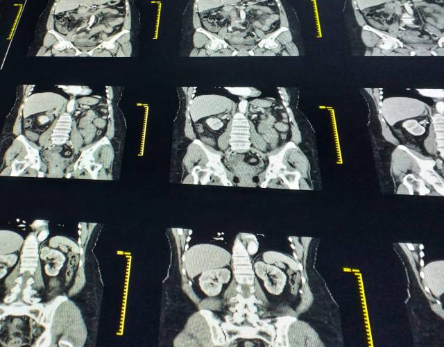 CT abdomen algemeen