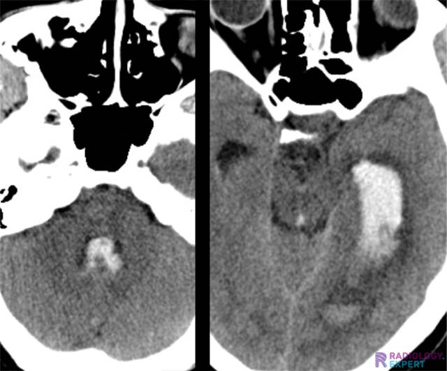 Extensive intraventricular blood in the left lateral ventricle, the aqueduct and the 4th ventricle.
