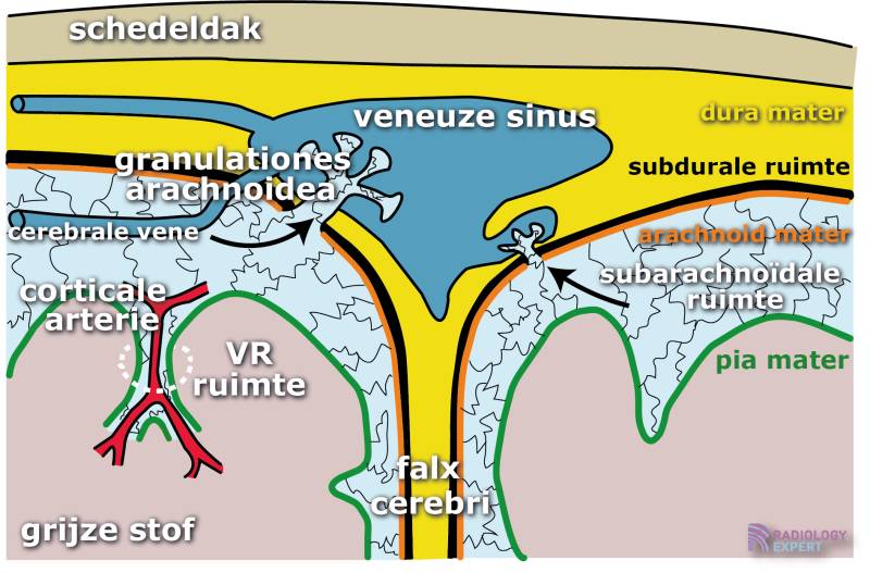 CT hersenen bloeding