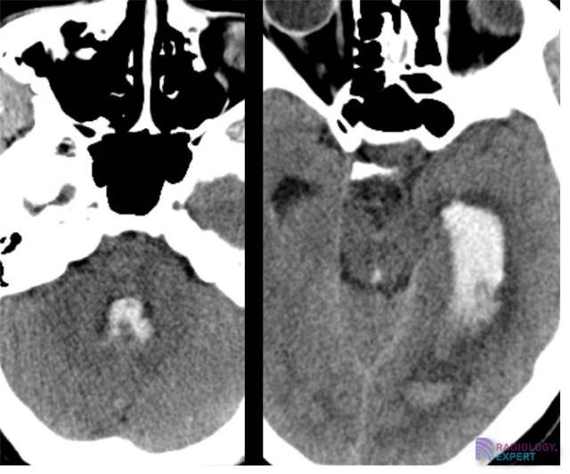Uitgebreid intraventriculair bloed in de linker laterale ventrikel, het aquaduct en de 4e ventrikel.
