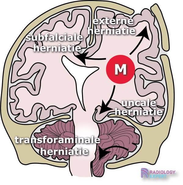 CT hersenen bloeding