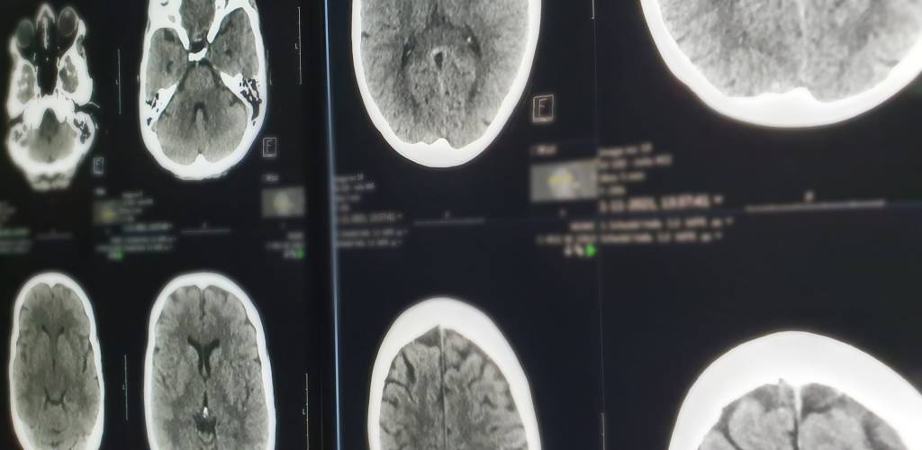 CT hersenen bloeding