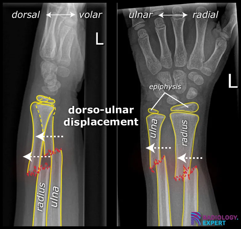 radius shaft and ulna shaft fracture