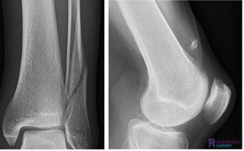 Spiral fracture en avulsion fracture of the quadriceps tendon