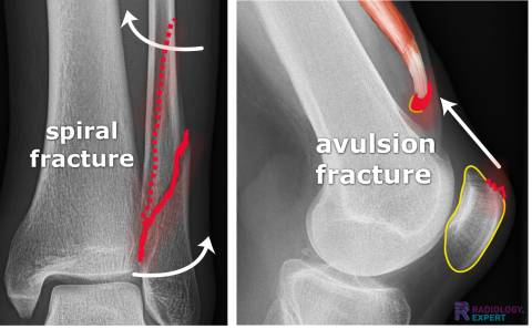 Spiral fracture en avulsion fracture of the quadriceps tendon