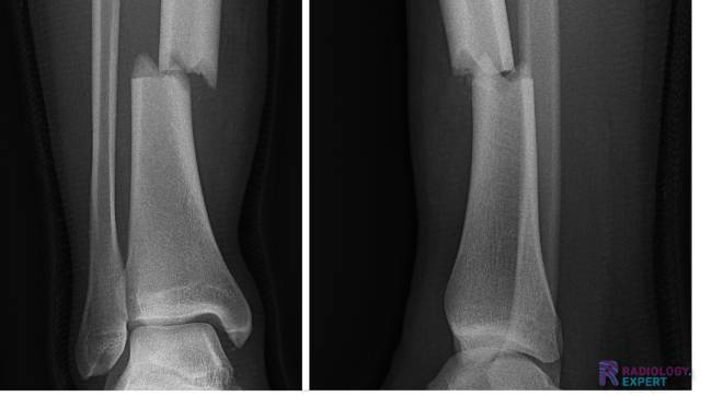 Description fracture dislocation