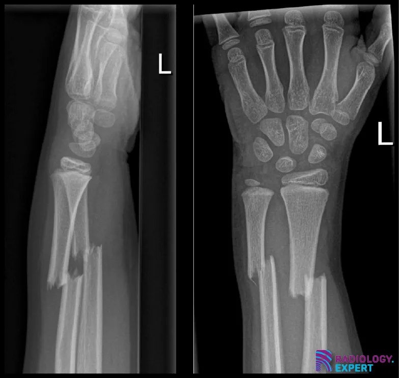 radiusschacht en  ulnaschacht fractuur.