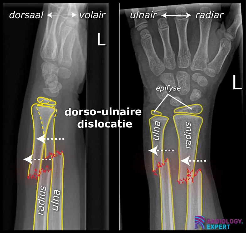 radiusschacht en  ulnaschacht fractuur.