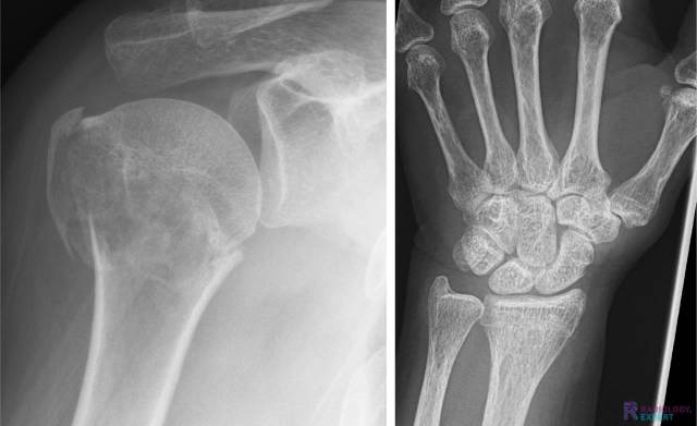 Fractuur gap een geïmpacteerd fractuur 