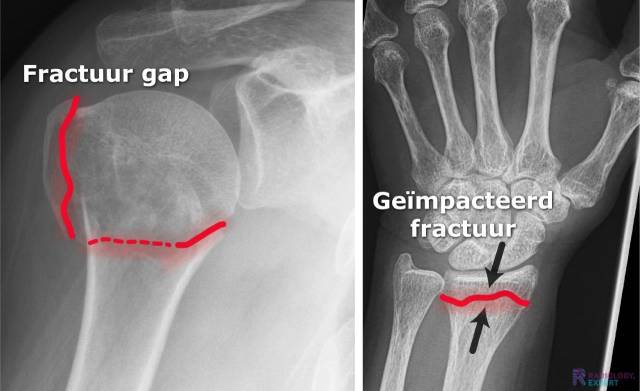 Fractuur gap een geïmpacteerd fractuur 