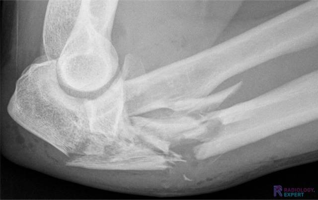 Open intra-articulair comminutief fractuur