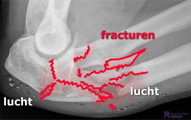 Open intra-articulair comminutief fractuur