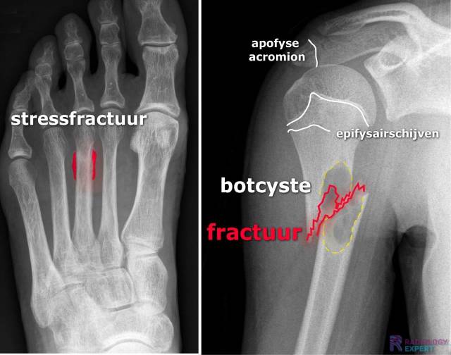 stressfractuur en pathologisch fractuur