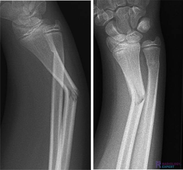 radius greenstickfractuur en een torus fractuur van de ulna